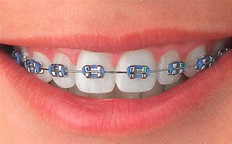 precio de brackets metalicos en peru|precio de los brackets dentales.